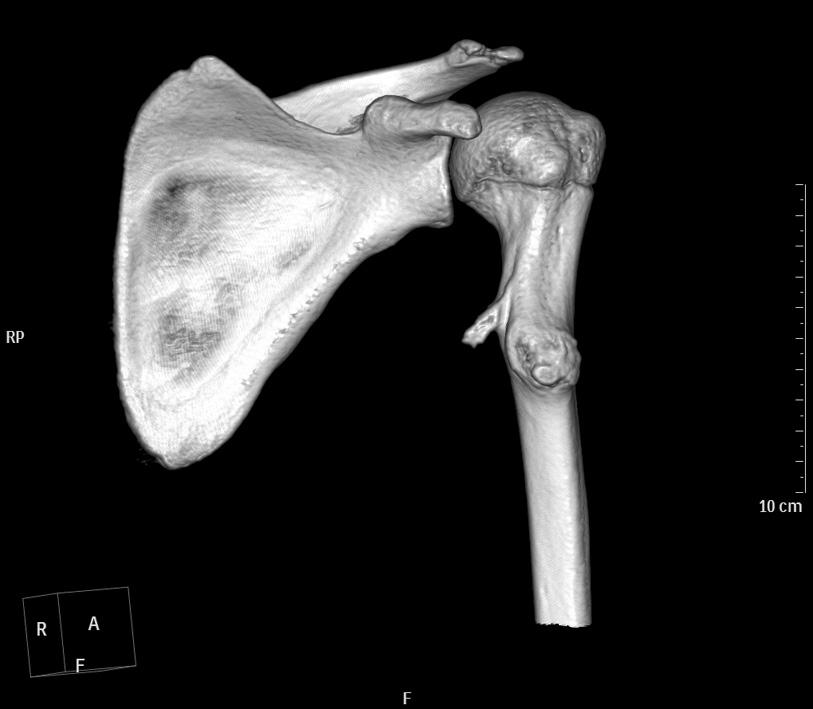 (C) Axial CT image demonstrates that this osteochondroma has a sharp beak
