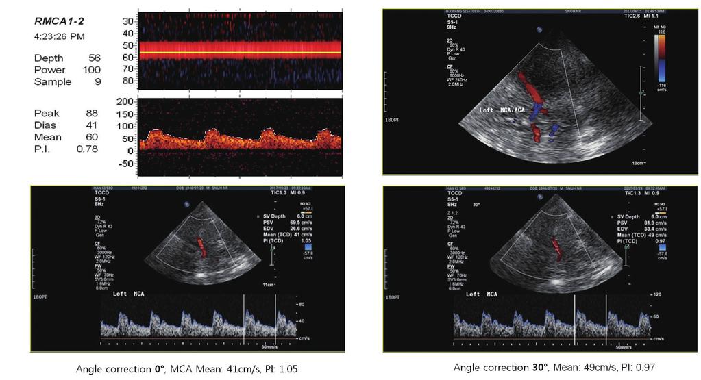 Vol. 10 / No. 1 / June 2018 Journal of Neurosonology and Neuroimaging A B C D Fig. 1. Methods of Blind-TCD, Image-TCCD, and AC-TCCD. (A) Doppler spectral signal by Blind-TCD.