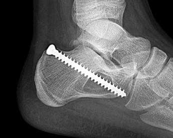 소아의고립성골낭종치료에서골수강내감압술의효과 457 Fig. 2. (A) A unicameral bone cyst in proximal femur of a 6 year old girl, which was incidentally found without fracture.