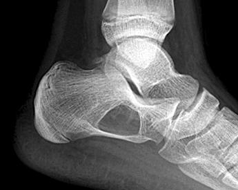 (D) But at 16 months it partially recurred at the same location. Final result of this case was classified as the 'recurrence after healing'. Fig. 3. (A) A calcaneal cyst in a 15 year old boy.