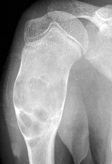 (A) Preoperative plain radiograph shows radiolucent cystic lesion in the proximal humerus.