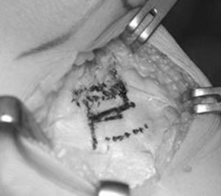 (D) Guide wire insertion under the fluoroscopy.