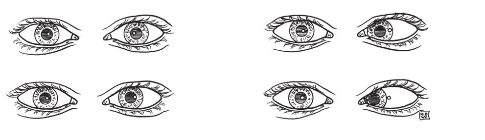 Oh S-Y, et al. Tests for Ocular lignment Examiner s view CN VI LR MR MR CN VI LR LR MR MR LR Right eye CN IV CN IV Left eye Left eye Right eye Fig. 2.