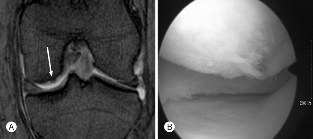 슬관절 연골 병변에 대한 관절경과 일상적 MRI의 비교 Fig. 2. (A) Coronal gradient echo MR image shows more than 1cm sized uneven thinning (arrows) of articular cartilarge of medial femoral condyle (Grade Ⅲ).