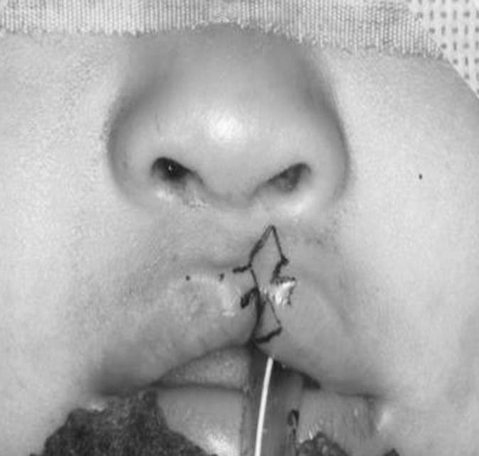Hye Jeong Park: Unilateral Incomplete Lesser Form Cleft Lip 181 Fig. 6.