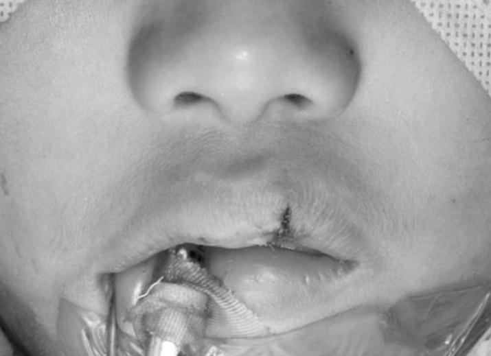 Onizuka 등[6]은 좀 더 나아가 nasal cleft lip, lip cleft lip, vermillion cleft lip으로 나누고 각각의 형태학적 특성과 후 dry vermillion은 7-0 nylon으로, lip mucosa는 6-0 vicryl로 수술적 관점에서 subgroup을 설정하였으며 이 기준을 적용하면 interrupted