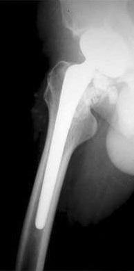 The right hip (A)  view at
