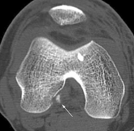 bony fragment on the medial aspect of the lateral femoral condyle.