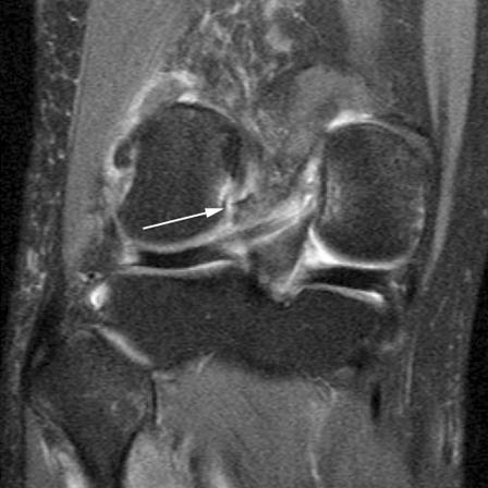 show avulsion fracture at the femoral attachment of the anterior cruciate