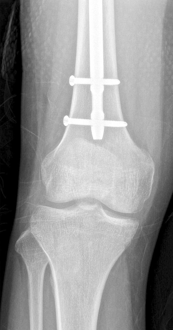And postoperative 6 months knee anteroposterior (C) and lateral (D) image show no abnormal findings. 슬관절의 인대 손상이 동반될 수 있으며, 그 빈도는 5%-48% 정도로 다양하게 보고되고 있다.
