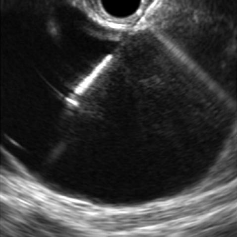 septum in front of pancreas. Fig. 2.
