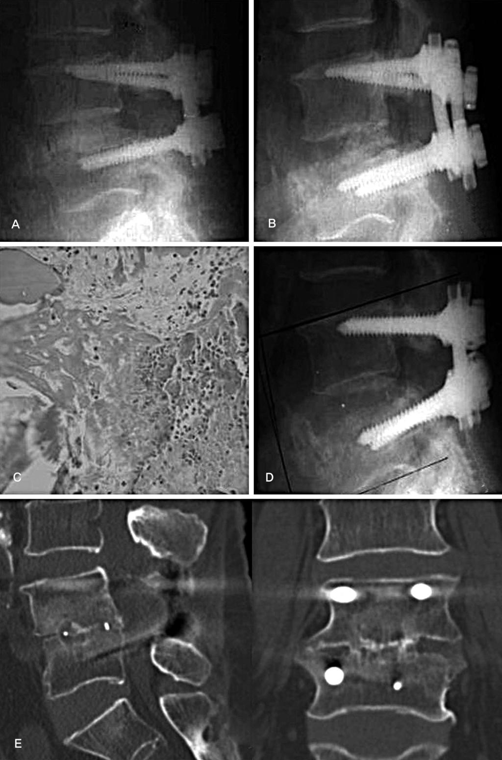Chae Hyun Lim et al Volume 19 Number 4 December 2012 Fig. 4. Revision for one case of allograft group. At 6-months follow-up, radiograph shows loss of disc height and absorption of the allograft (B).