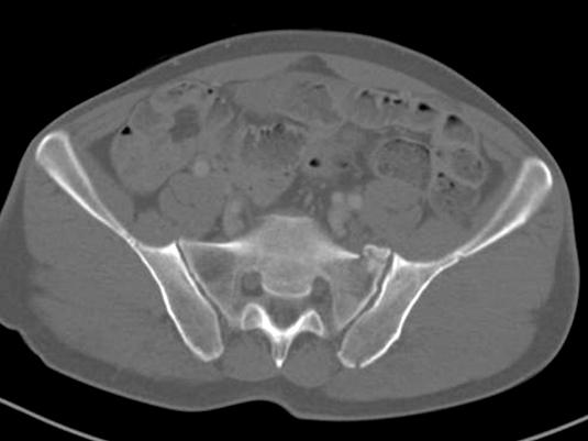 a LC-I pelvic injury show anterior compression fracture of left sacral ala with both pubic rami fractures.