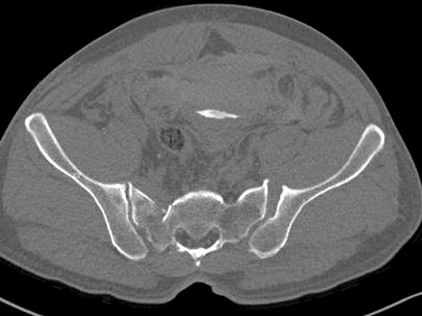 and three-dimensional image (C) of an APC-II pelvic injury show diastasis of