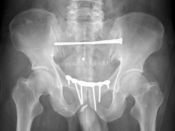 fixation with S2 iliosacral screw fixation due to sacral dysmorphism.