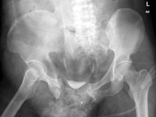 Preoperative pelvis anteroposterior radiograph (A), computed tomography scan axial