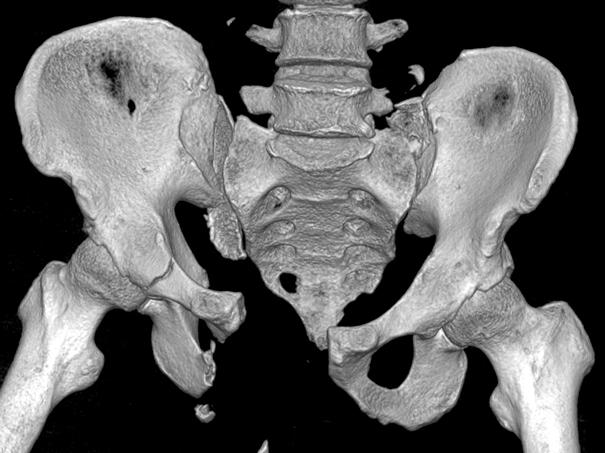 injury of the left hemipelvis.