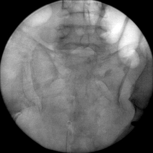 Intra-operative image of C-arm fluoroscopy (B) shows opening of the right SI joint with complete disruption of the left SI joint.
