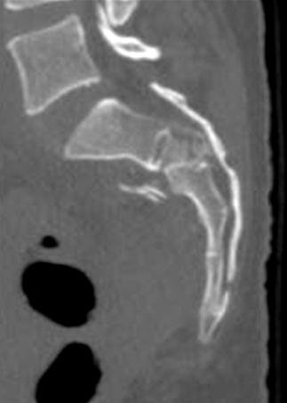CT scan three-dimensional image (C) shows a U-shape sacral jumper s fracture with coronal fracture of S1 body.