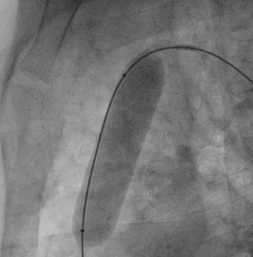 (transvalvular pressure gradient) 는 67 mmhg 로중증의폐동맥판막협착증 (pulmonary valve stenosis, PS) 소견을보였다 (Fig. 2).