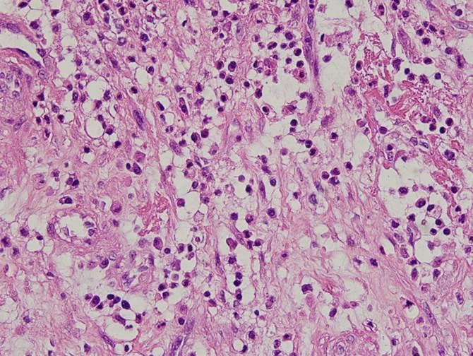 (A) The valves showed marked acute inflammation with microabscesses (arrow) and granulomatous tissues (hematoxylin and eosin [H&E] staining, 40).
