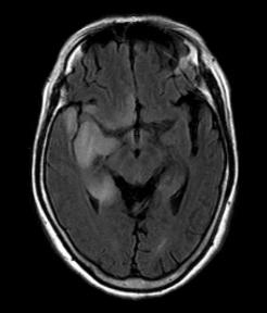 건반사는좌우대칭이었고병적반사는없었다. 내원당일시행한뇌자기공명영상 (MRI) 에서는양측측두엽과전두엽하방에고신호음영이보였고우측이심하였다 (Fig. 1-A). 뇌척수액검사에서뇌압은 150 mmh 2O이었고무색, 무취였다. 백혈구수는 133/mm 3 로림프구가 95% 였다.
