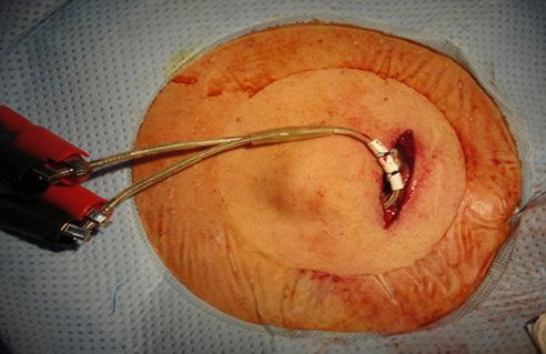 the fracture site and venoplasty was performed for