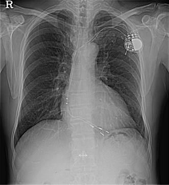 - 대한내과학회지 : 제 88 권제 2 호통권제 654 호 2015 - A B Figure 3. (A) Final X-ray after implantation of a generator and lead. (B) Well-functioning pacemaker. 고찰전극선골절은인공심박조율기를삽입한환자의 1-4% 에서발생하는흔한합병증이다 [1,2].