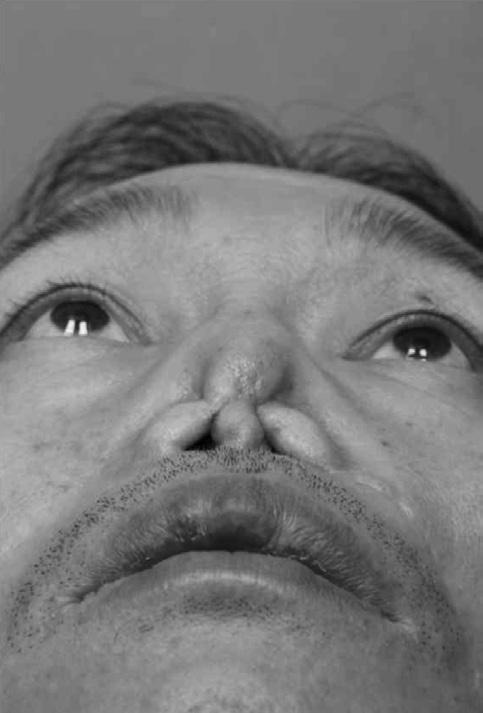 연구개누공 과 구인두협착 이 확인되었고 컴퓨터단층촬영에서도 같은 소견이 관찰되었다 코입술 피판 사용으로 인한 양측 비구순구 의 상흔이 관찰되었다 환자의 코 재건을 위해 단계에 걸친
