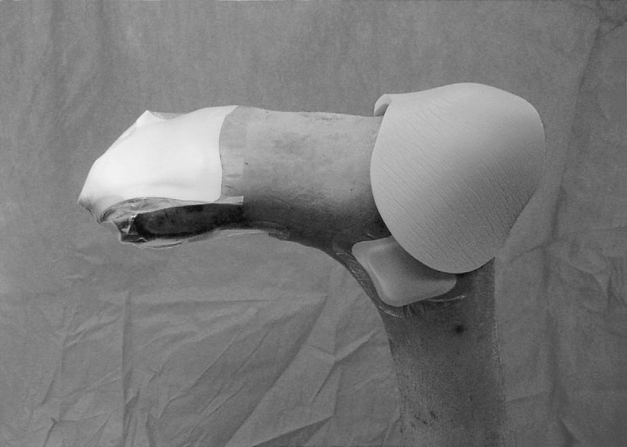 5 cm 개를 사용하여 각각 내과와 외과의 골이 두 드러진 부위에 부착한 후 부츠 모양의 포말 드레싱(10 10 cm)을 이용하여 후족부 후방과 족저부에 고정하였다(Fig. ).