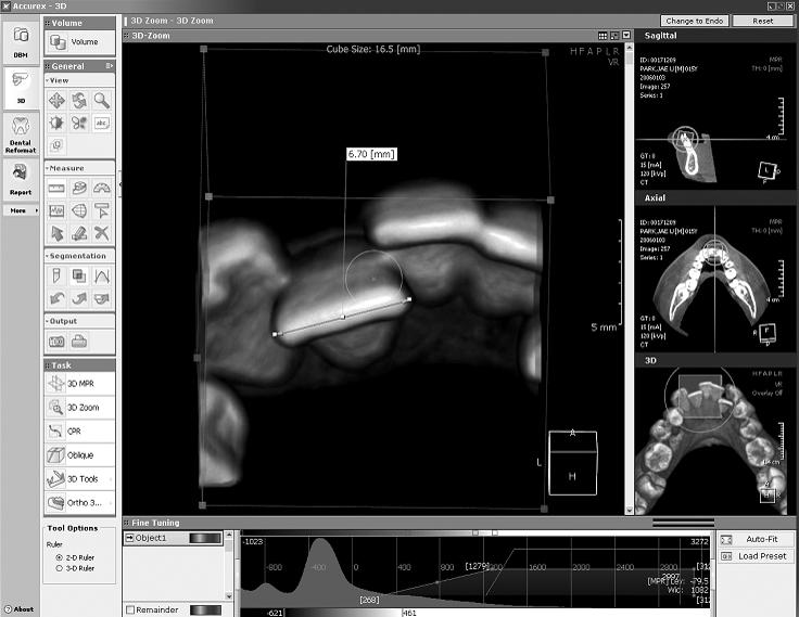 임미영, 임성훈 대치교정지 39 권 1 호, 2009 년 Fig 1. Measurements of tooth size and dental arch width of a laser scan digital model. 3DXer ver 3.5 was used. 치, 제 2 소구치의근원심폭경의합을각악궁의필요공간으로하였다.