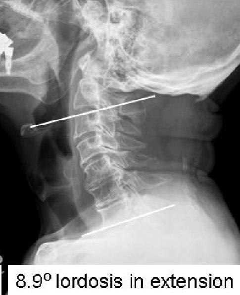 Postoperative and 2-year follow up cervical spine lateral radiograph shows