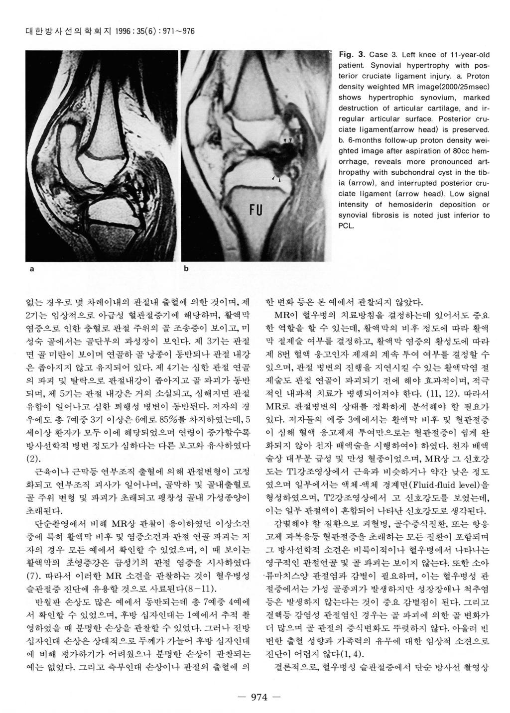 대한밤사선의학회지 199: 35(): 971-97 Fig. 3. Case 3. eft knee of 11-year-old patient. Synovial hypertrophy with posterior cruciate ligament injury. a.