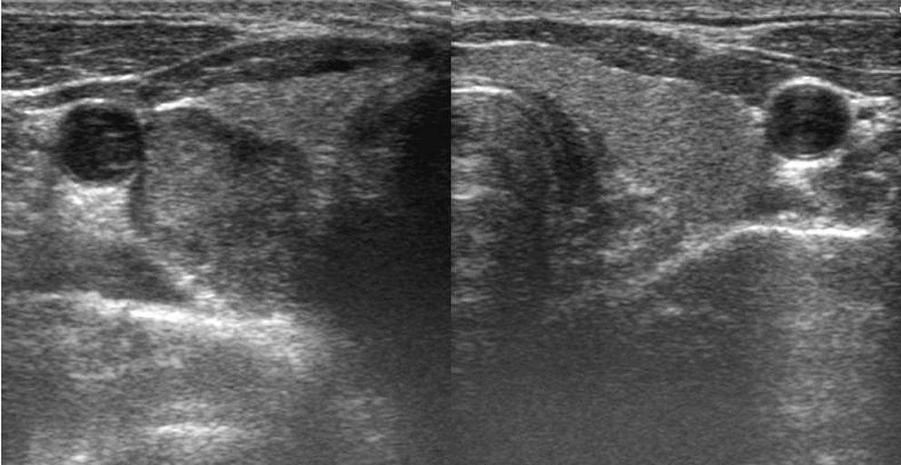 5. Lateral view of both tibias shows multiple osteolytic lesions with sclerotic rim in tibias and