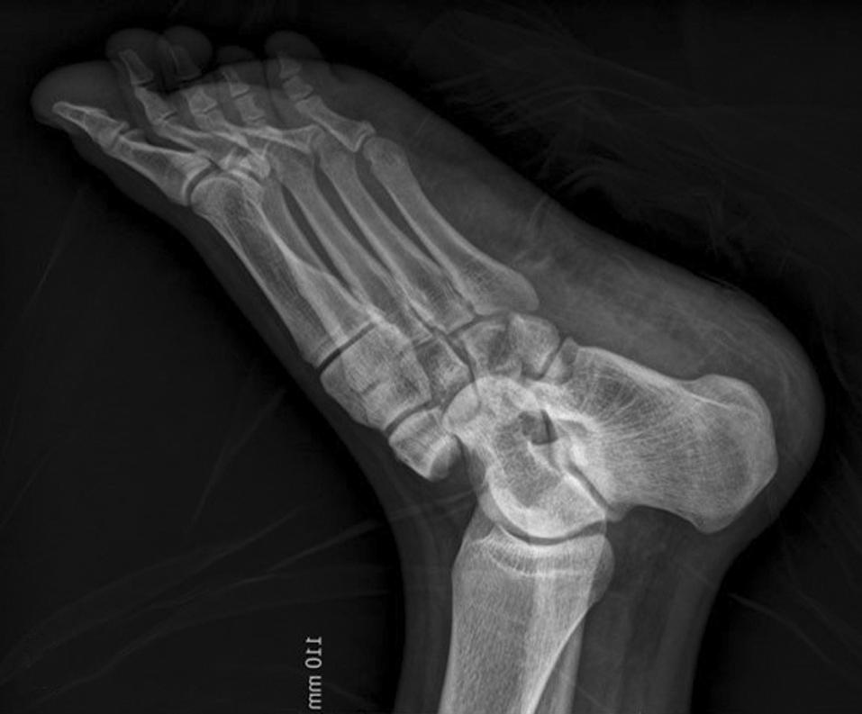 121 Sung-Hyun Kim, et al. Chopart Joint Fracture and Dislocation Figure 1.