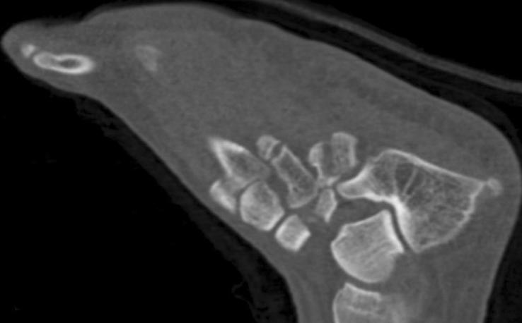fracture and dislocation of calcaneocuboid joint (C). C 족관절 원위 경골 골절(distal tibia fracture), 천골 골절(sacrum)이 관찰되었다.