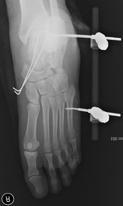 K-wire, cortical screw fixation and bridging plate internal fixation were done respectively in navicular bone fracture and cuboid bone fracture. mm) 및 피질골나사못(cortical screw; diameter 2.