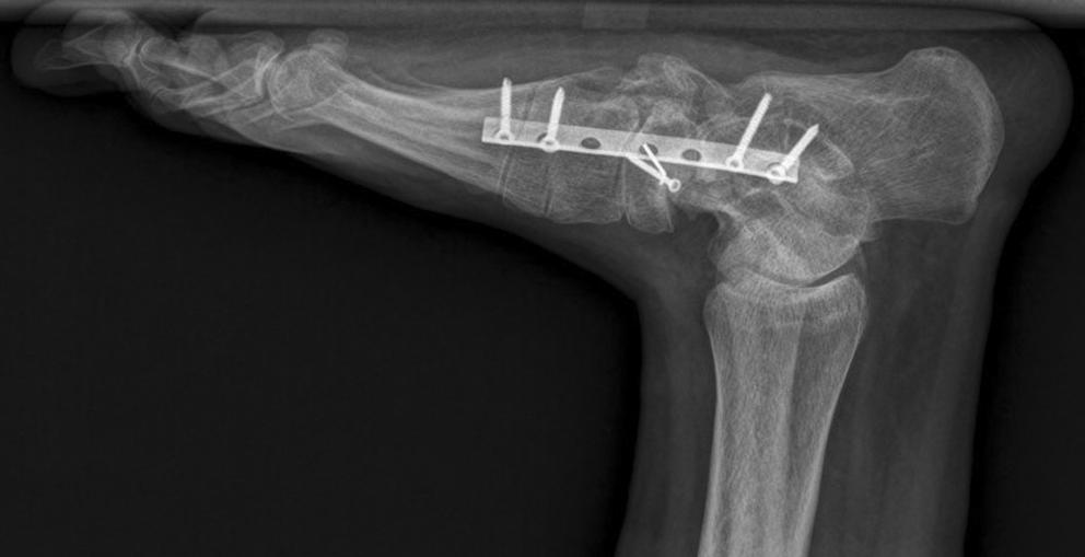 ridging plate was removed (). Dislocation of talonavicular jointand flat foot deformity were observed (, ).