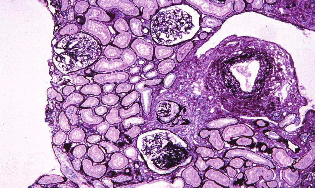 22 J Korean Soc Pediatr Nephrol Vol. 16, No. 1, 21-31, 2012 역사와 배경 1925년 Fahr[1]는 lipoid nephrosis로 진단된 후 사망한 환자의 부검에서 사구체의 분절성 경화증이 있다는 것을 기술하였다.