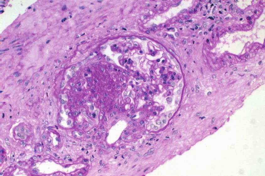 에서 환자의 연령에 맞는 정상 크기와 비교해 보면 다소 커 져있다는 것이 증명되었다(Fig. 5) [9, 10]. 따라서 조직검사에 나온 사구체 경화증이 없는 경우라도 사구체의 크기가 정 상보다 커져 있는 경우는 FSGS의 가능성의 가능성이 있다. 4.