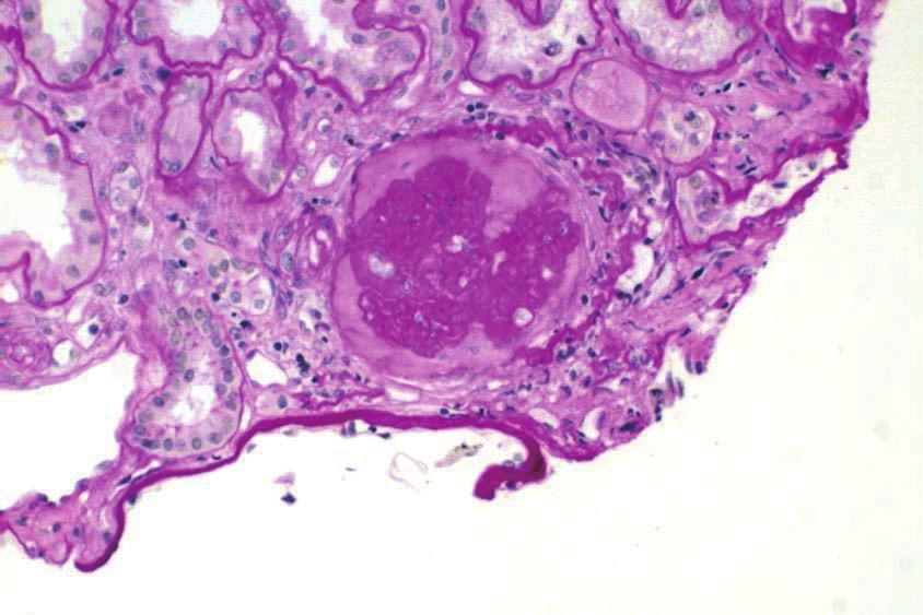 예를 들면 FSGS 형태가 포함된 Ig 신증 등이다. 또 다른 증식성 병변으로는 족세포(podocyte)의 증식을 들 수 있다. 이것을 1985년 Schwartz 등[11]은 증식형 FSGS로 분류하기도 하였으나 지금은 허혈형(collapsing type, Fig.