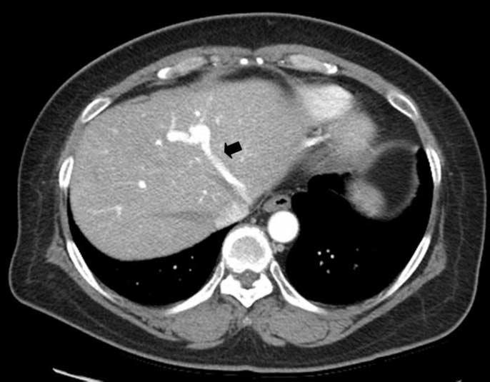 . xial CT scan shows early filling of left hepatic vein (black arrow) through shunt from left portal vein. Right and middle hepatic veins are not filled with intravascular contrast media. C. Coronal image shows direct communication (curved black arrow) between left portal vein (white arrow) and left hepatic vein (black arrow).
