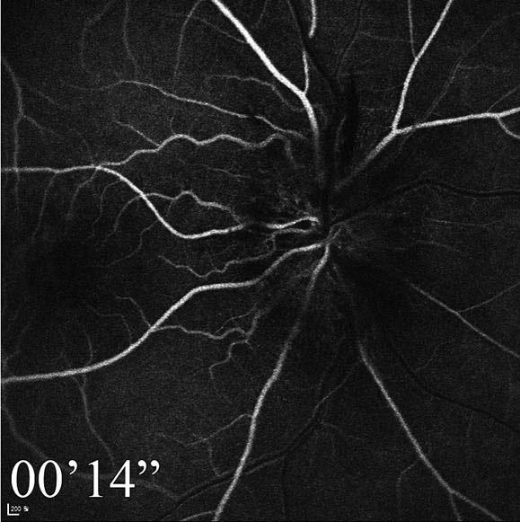 Fundus fluorescein angiography at the initial visit (,, ).