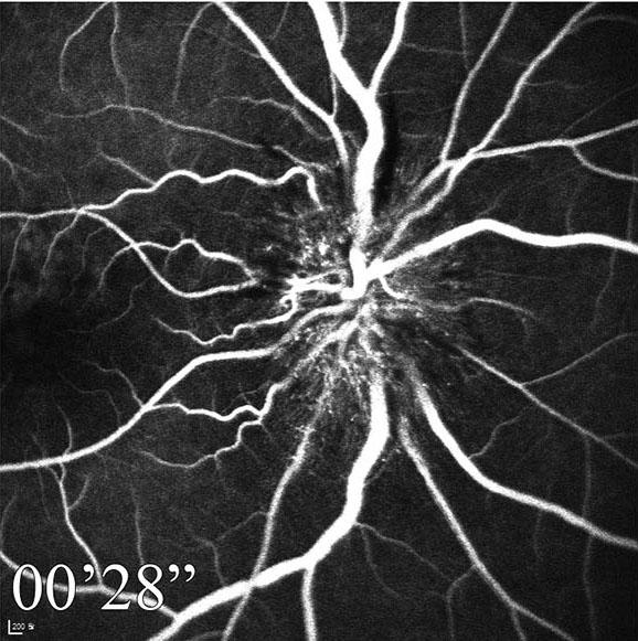 onsecutive optical coherence tomography (OT) images of the patient.