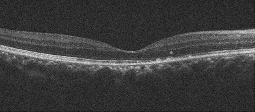 Six days after injection of bevacizumab, improvement of serous retinal detachment with decreased amount of subretinal fluid is