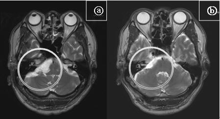 Korean J Clin Lab Sci. Vol. 45, No. 3, Sep. 2013 127 Fig. 8. Pre and Post operation MRI. a Before tumor remove. b After tumor remove. Fig. 10. FNEMG and BAEP in operation. Fig. 9.
