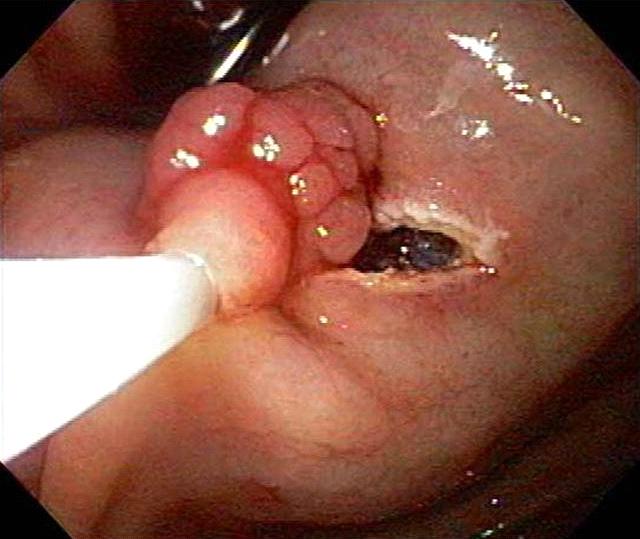 Figure 4. After polypectomy, there was no further bleeding. 병리조직 검사 결과 두 개의 용종 모두 융모샘종으로 확인 Figure 5.