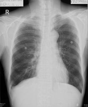 - 이영모외 6 인 : 고환종괴와폐출혈을동반한결절성다발동맥염 - Figure 4. Chest X-ray findings. () No active lesion was found in both lungs at initial admission.