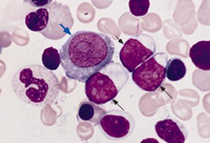 FAB classification M6 Bone marrow smear from a patient with erythroleukemia (FAB classification
