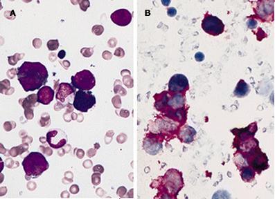 FAB classification M7 Bone marrow smear from a patient with acute megakaryoblastic leukemia Panel A shows large blasts and promegakaryocytes; the latter cells are larger than the blasts